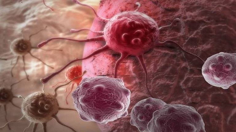 آنچه باید درباره سرطان پانکراس بدانیم