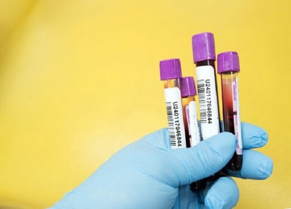 تشخیص خطر مرگ برای بیماران کرونایی با آزمایش خون