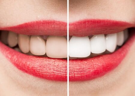 روشهای سفید کردن دندان در منزل